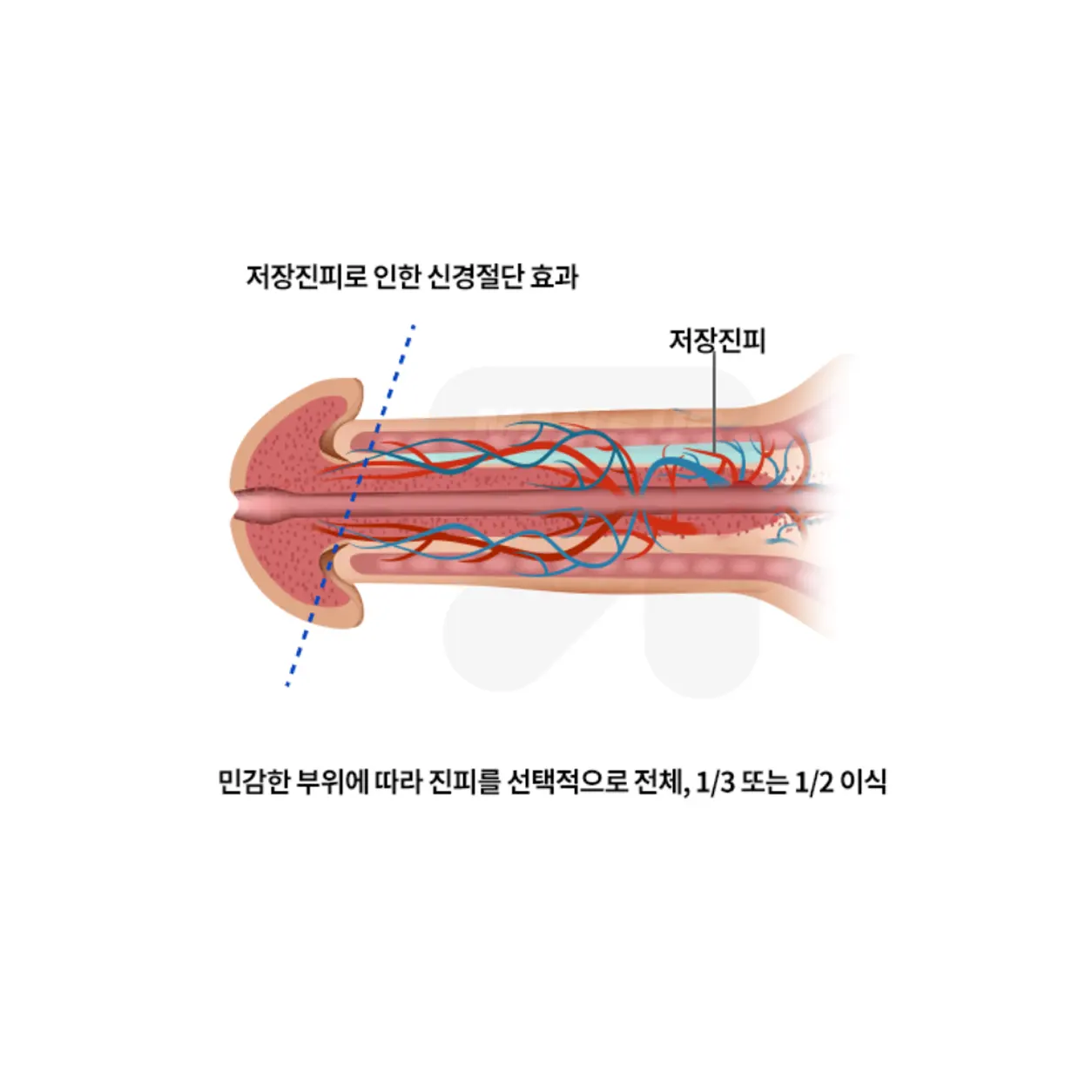 맨즈업 복합수술 미세신경완화 안내 이미지