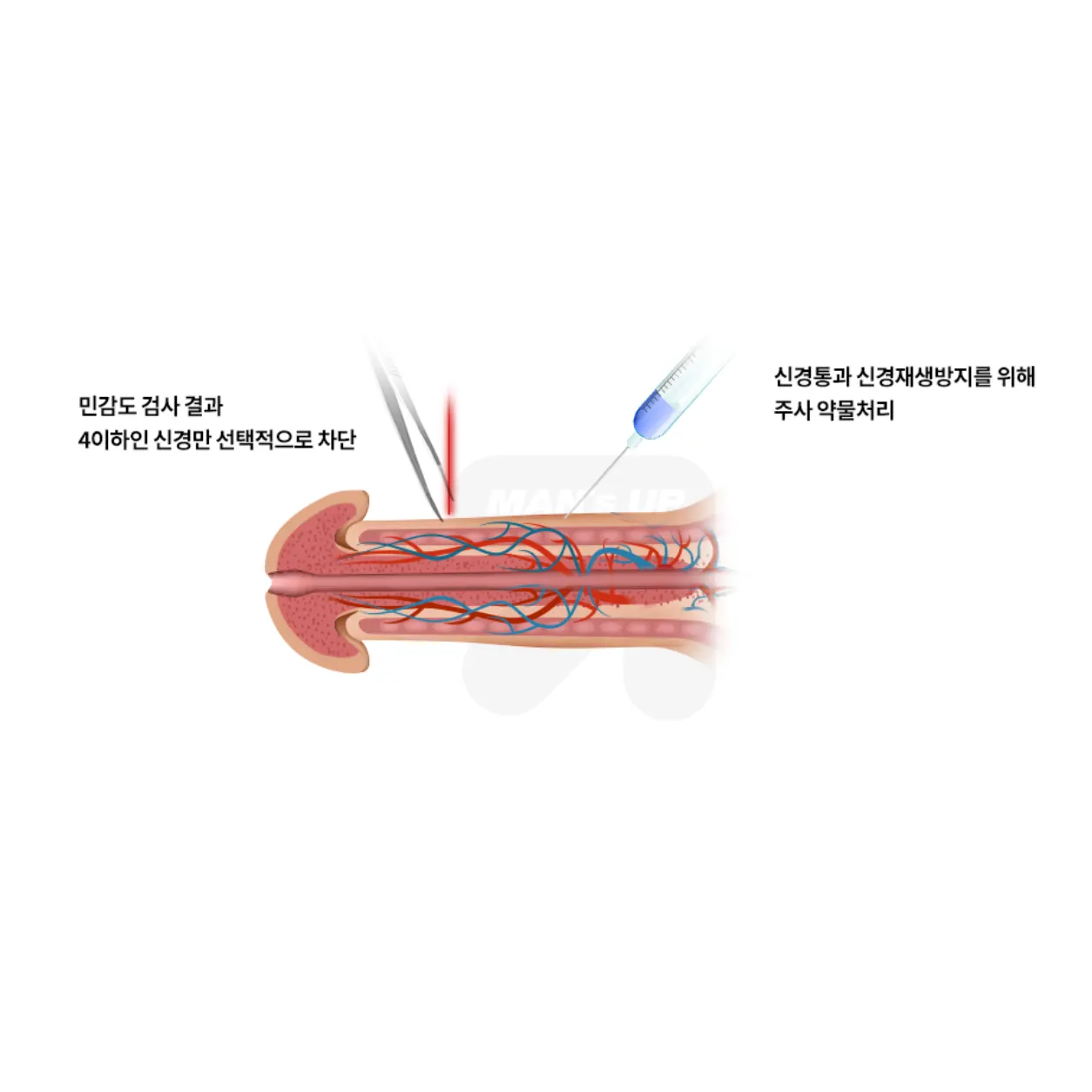 맨즈업 복합수술 조루수술 안내 이미지
