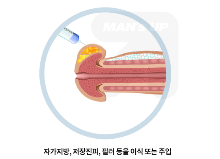 복합 귀두확대술 참고 도식