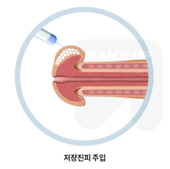 주사형 저장진피 귀두확대술 참고 도식