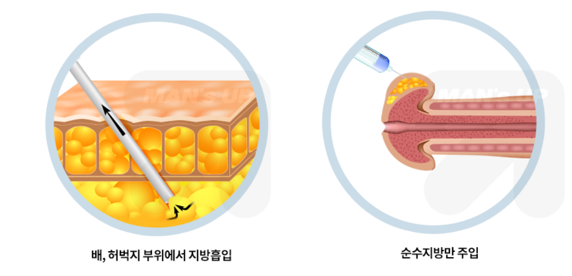 자가지방 귀두확대술 참고 도식