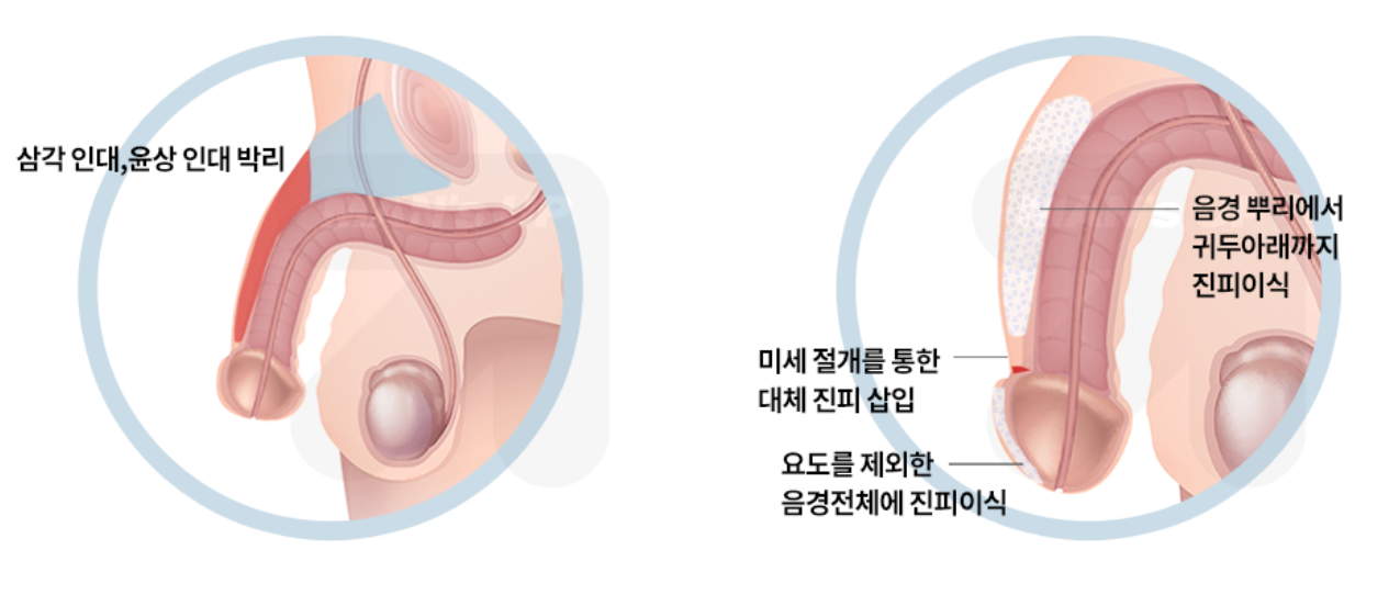 대체진피 음경확대술 참고 도식