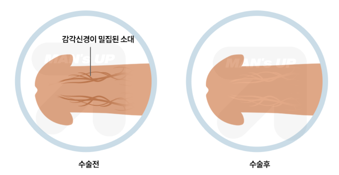 소대절제술 참고 도식